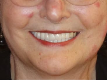 After: full mouth reconstruction with 10 implants