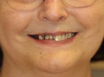 Before: full mouth reconstruction with 10 implants