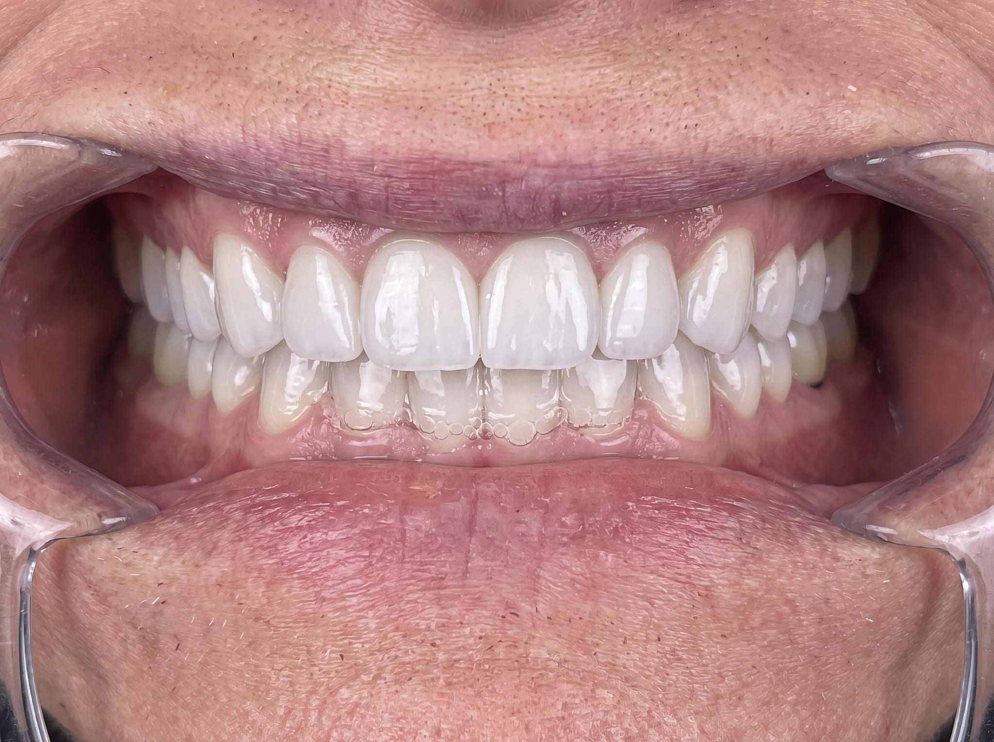 After: 7 implants with periodontal coordination