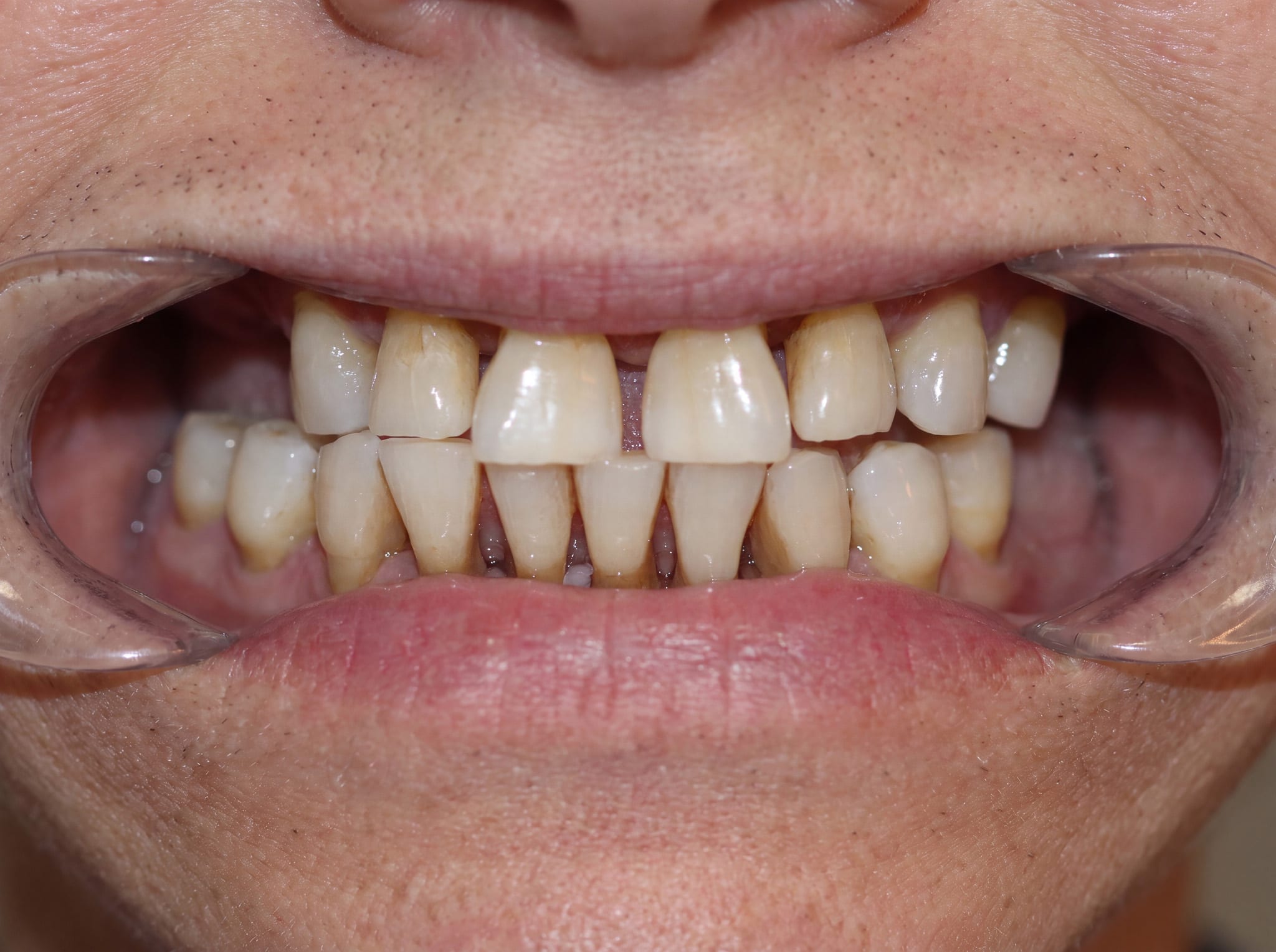 Before: 7 implants with periodontal coordination