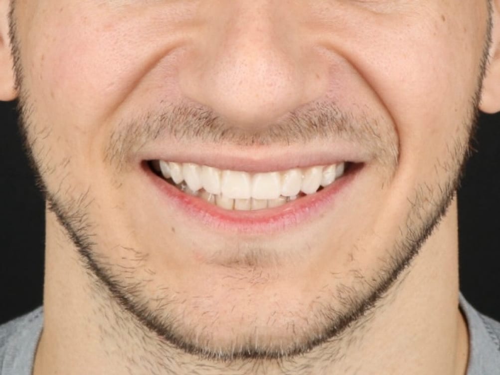 After: ceramic veneer reconstruction