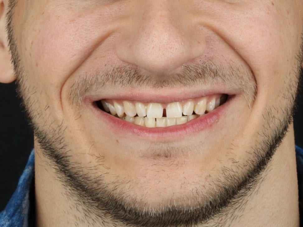 Before: ceramic veneer reconstruction