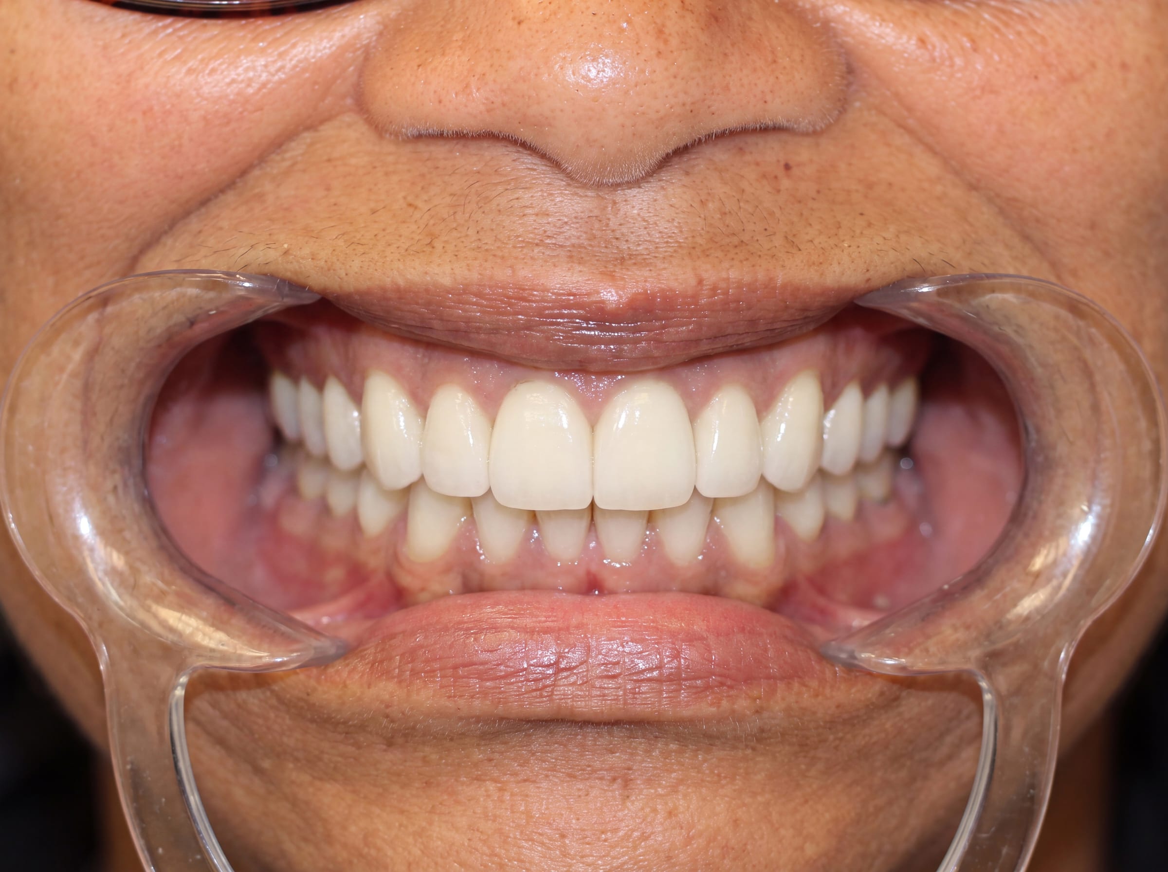 After: full mouth restoration with diastema closure