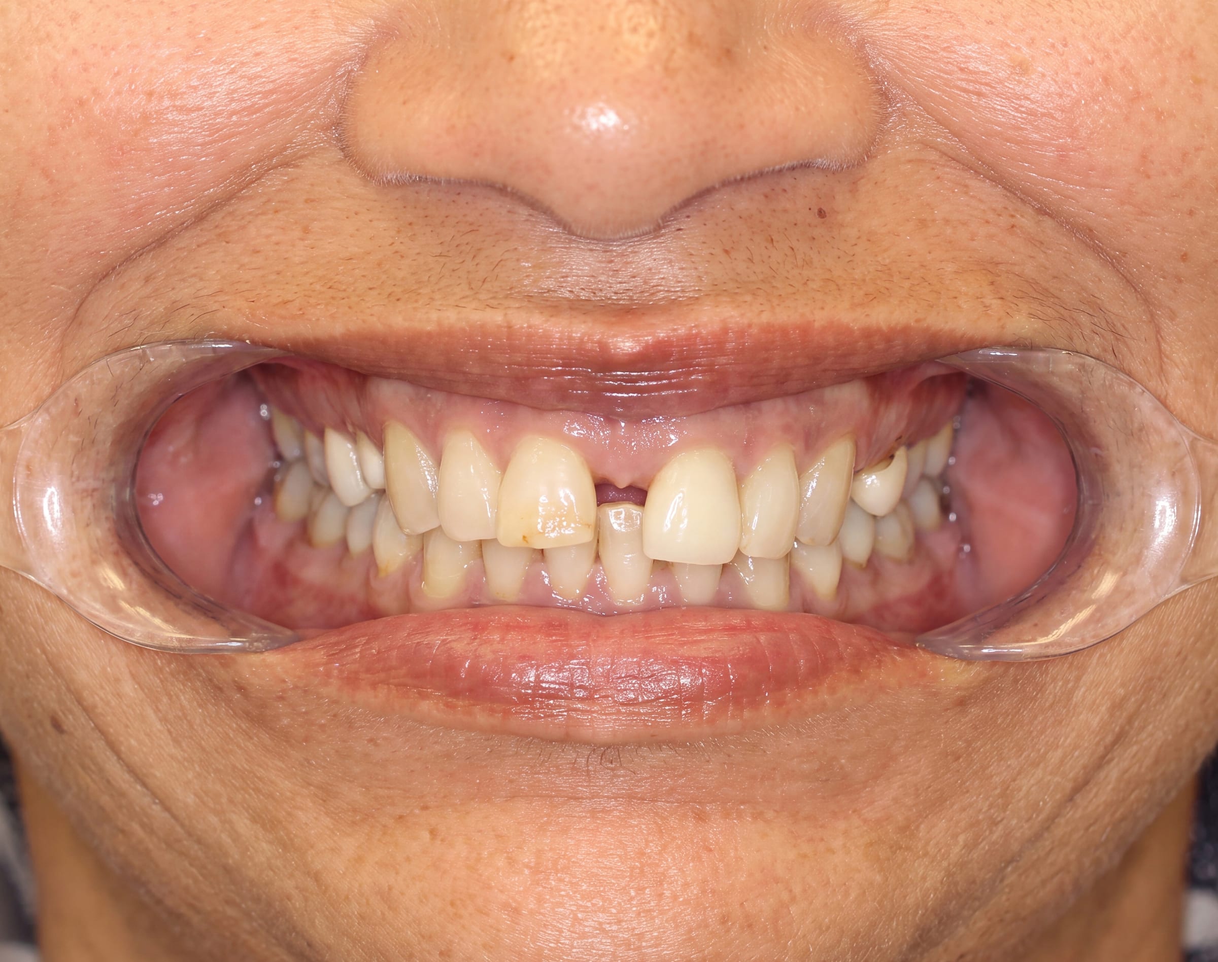 Before: full mouth restoration with diastema closure