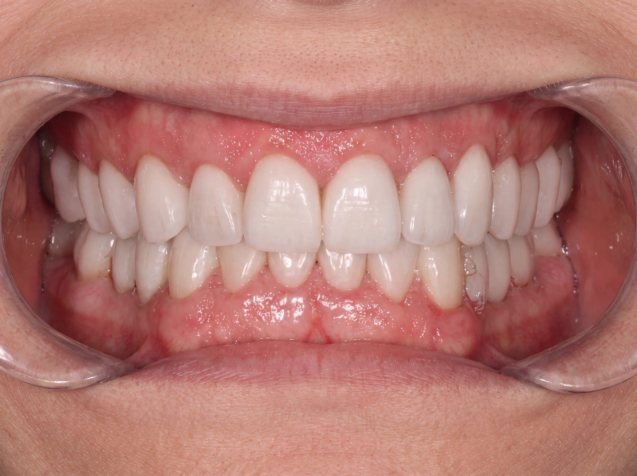 After: 5 implants after TMJ and jaw analysis