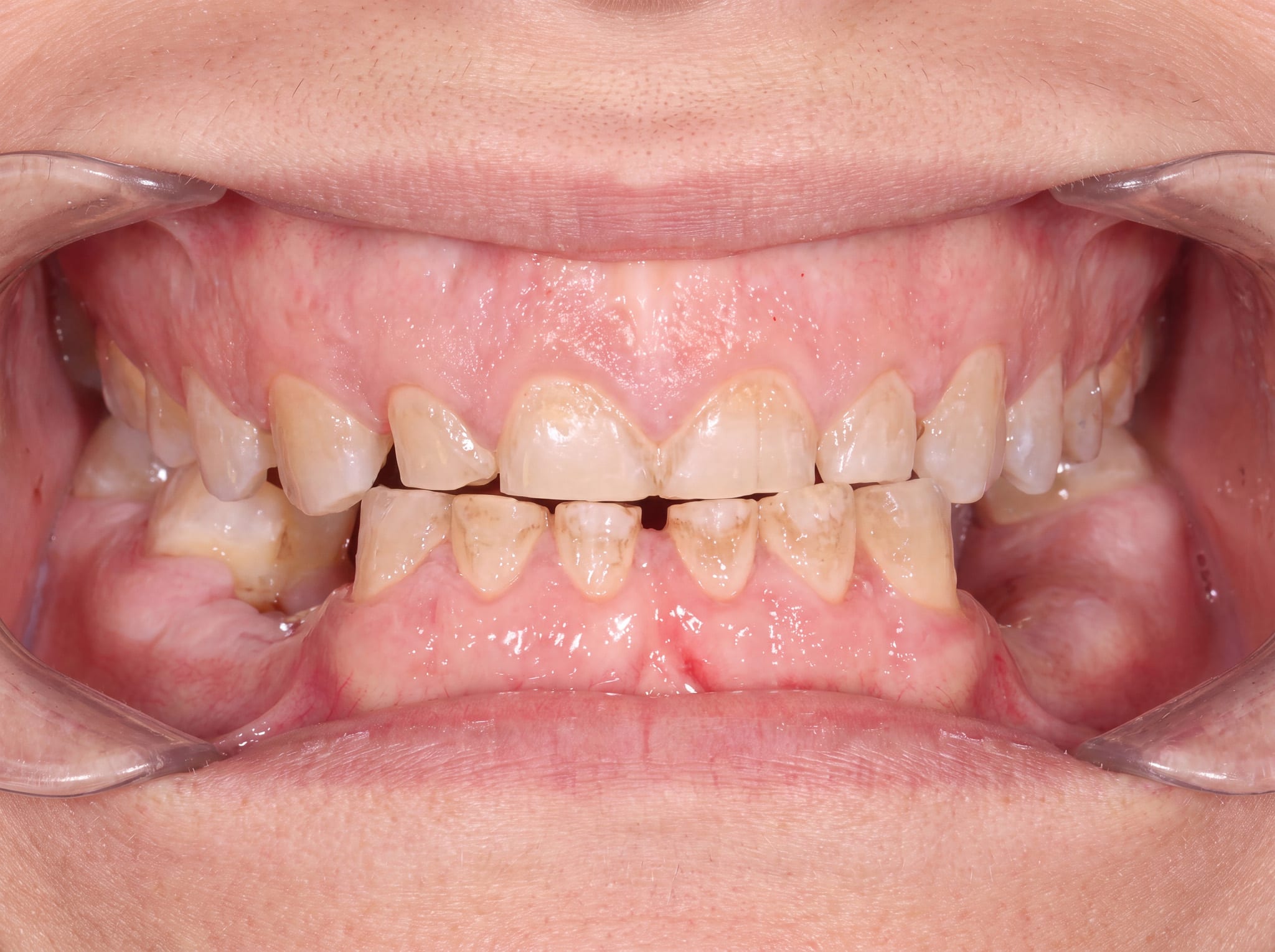 Before: 5 implants after TMJ and jaw analysis