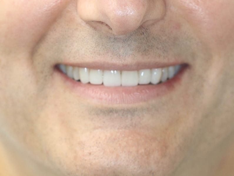 After: 10 ceramic veneers reversing severe wear