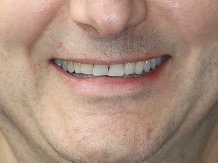 Before: 10 ceramic veneers reversing severe wear