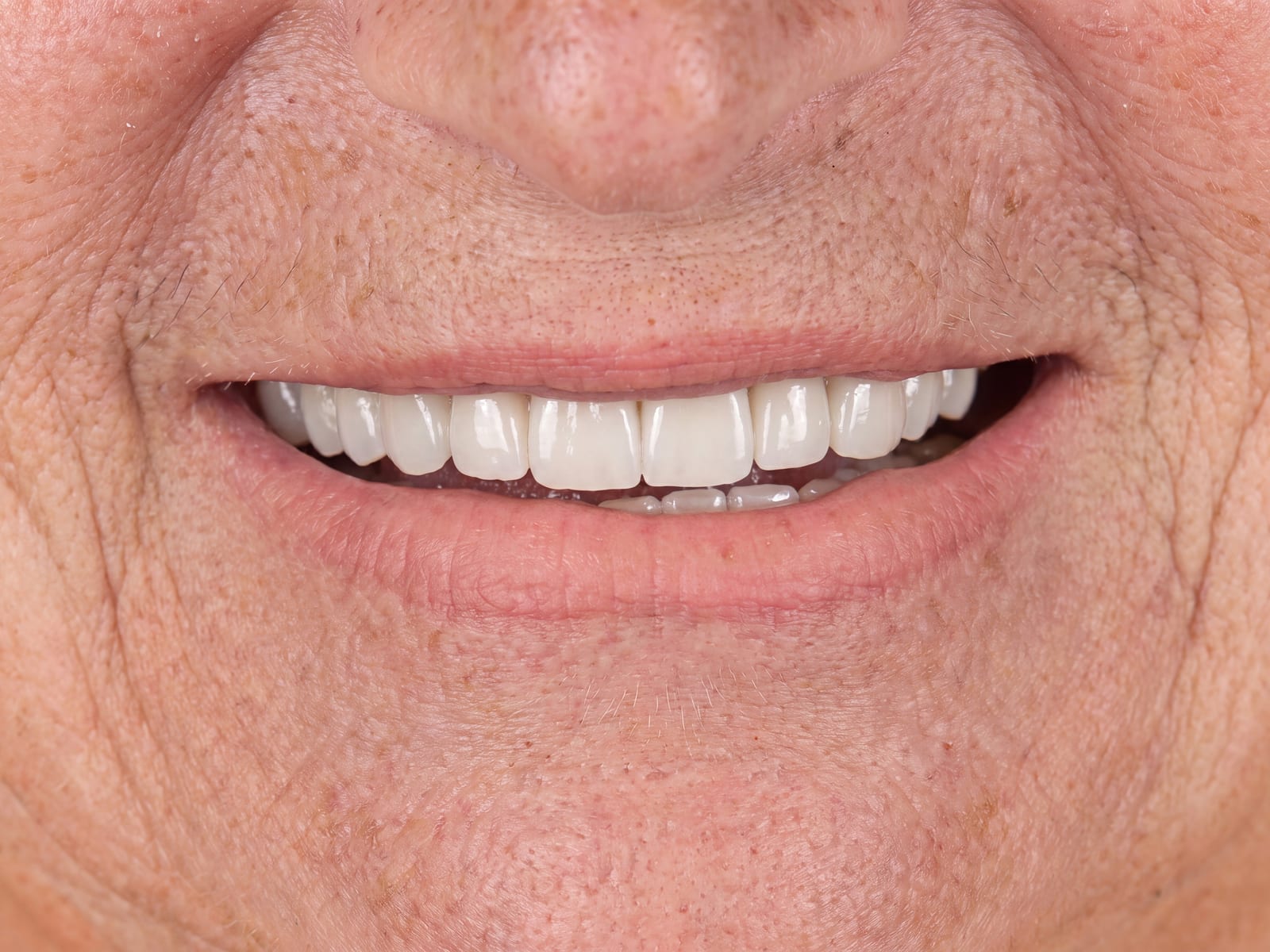 After full mouth ceramic rehabilitation — all-ceramic crowns restoring aesthetics and function