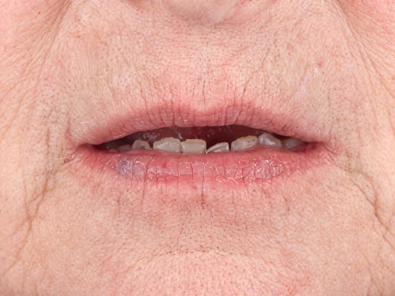 Before full mouth ceramic rehabilitation — worn dentition with collapsed vertical dimension