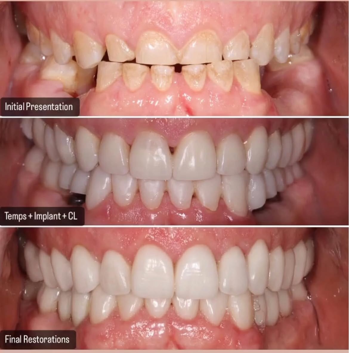 Featured case treatment progression — initial presentation, temporary restorations with implant and crown lengthening, and final restorations