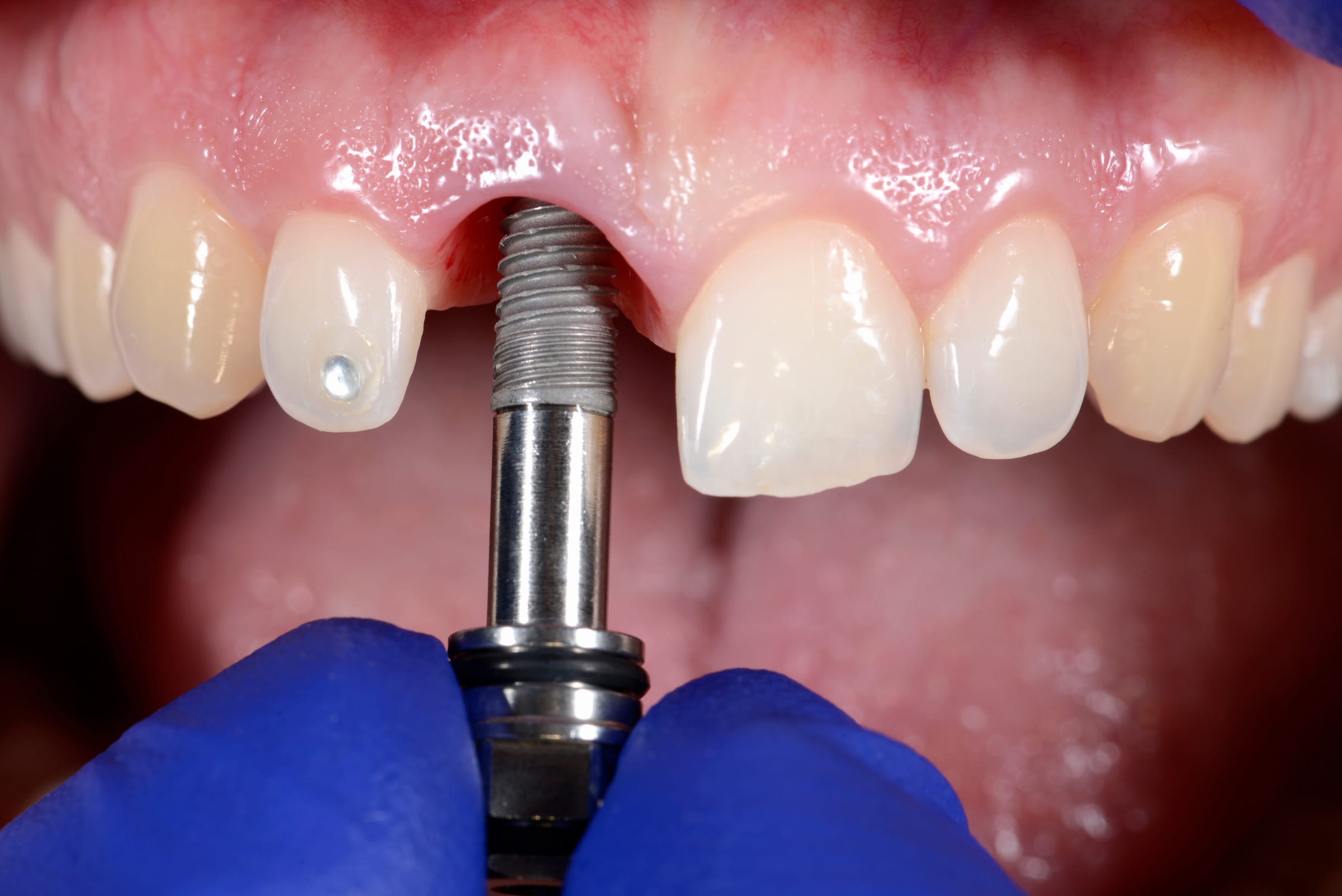 Single tooth implant abutment in the mouth before the crown is placed