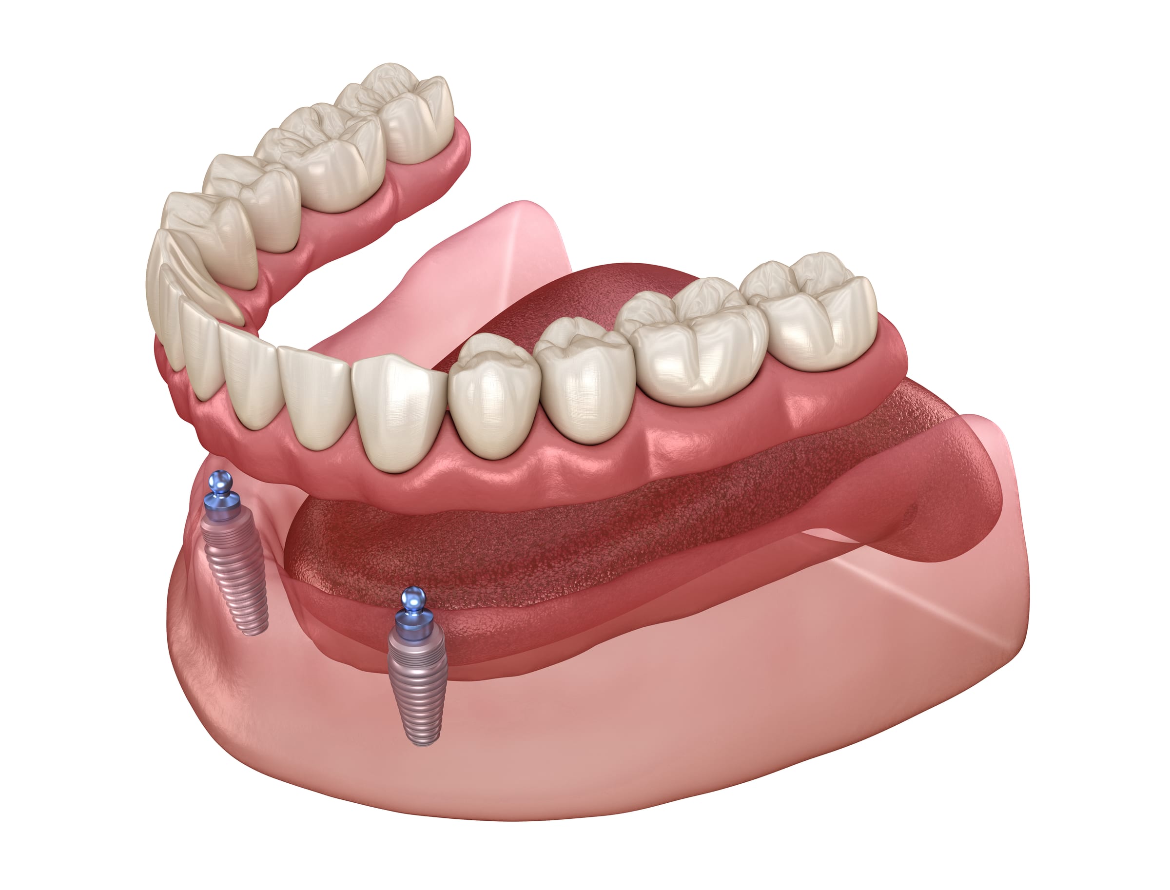 Illustration of an implant-supported overdenture on the lower jaw